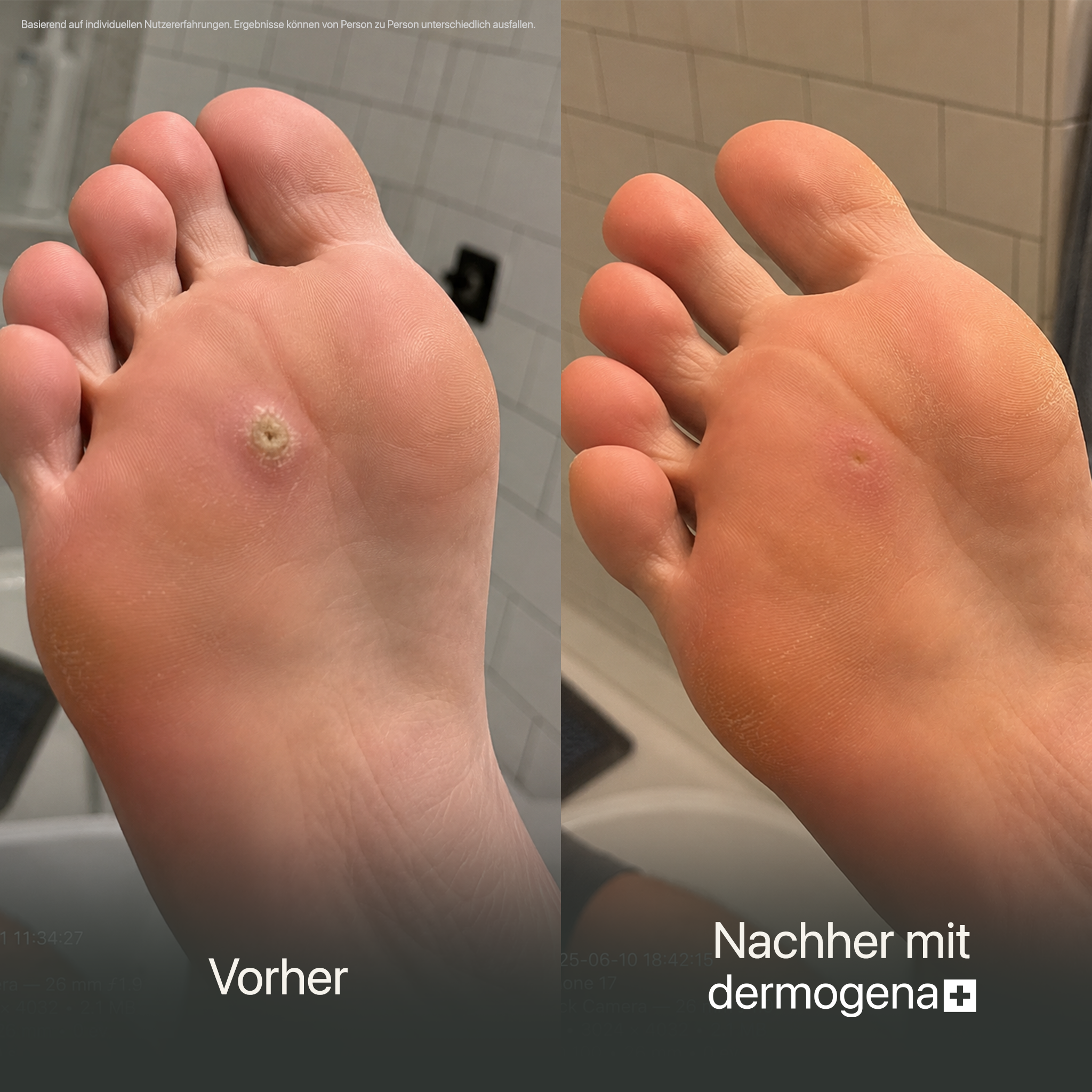 Dermogena Warzenpflegestift