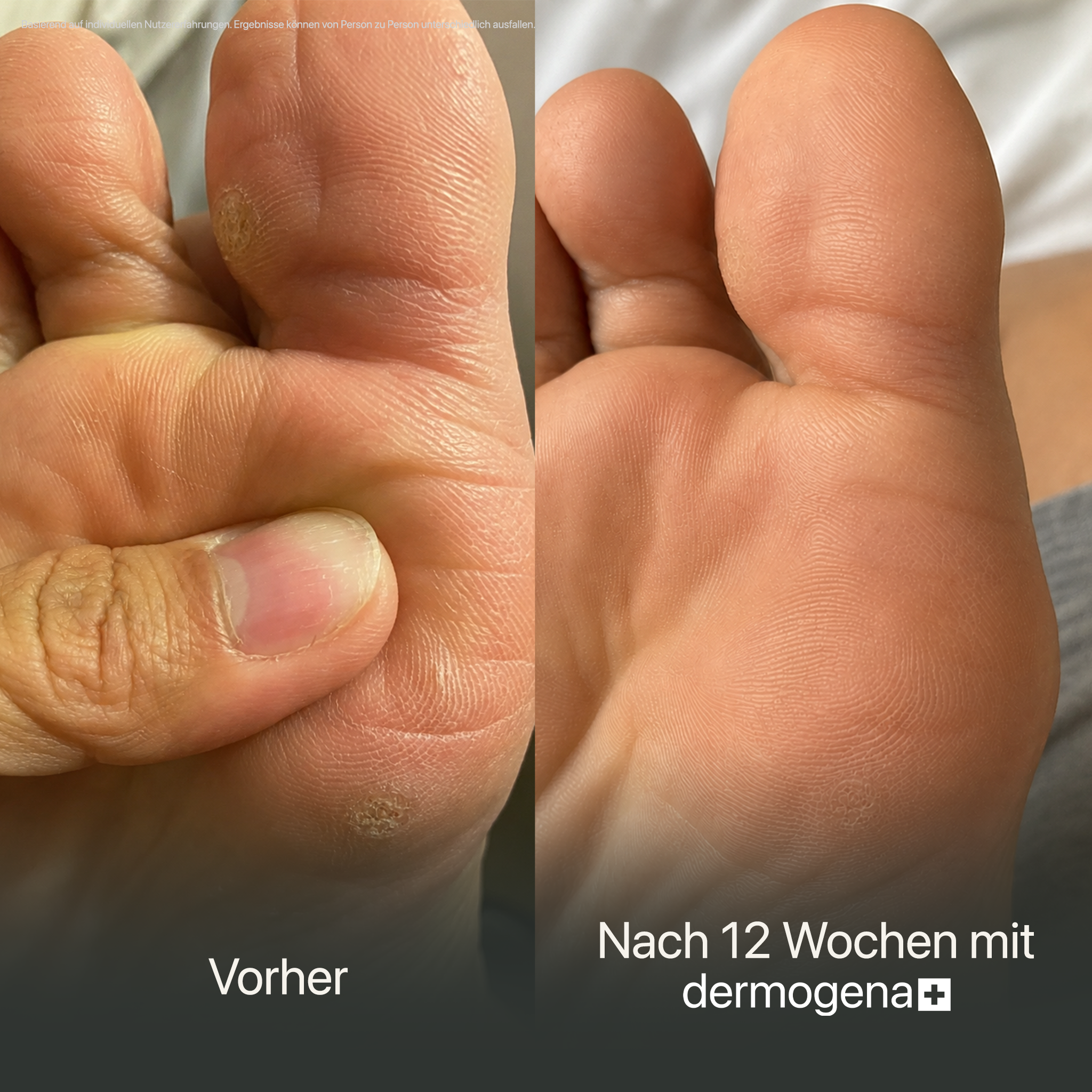 Dermogena Warzenpflegestift