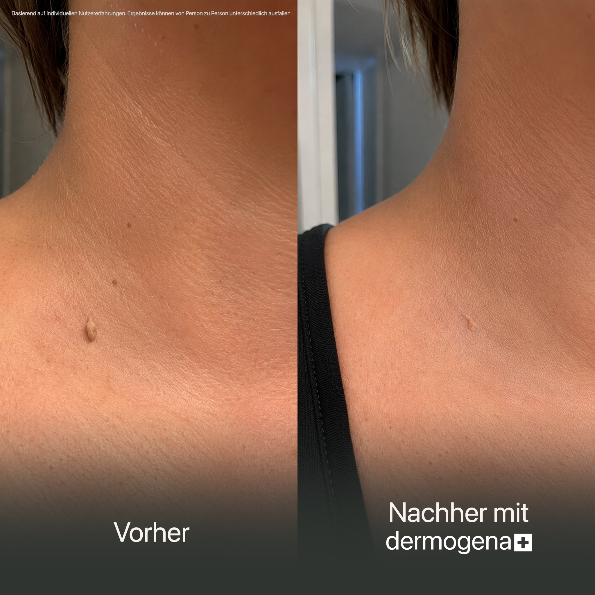 Dermogena Warzenpflegestift